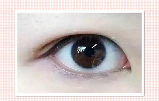 全切法的双眼皮