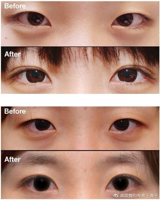 术后睁眼费力