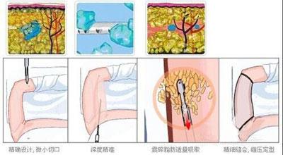 手臂吸脂术