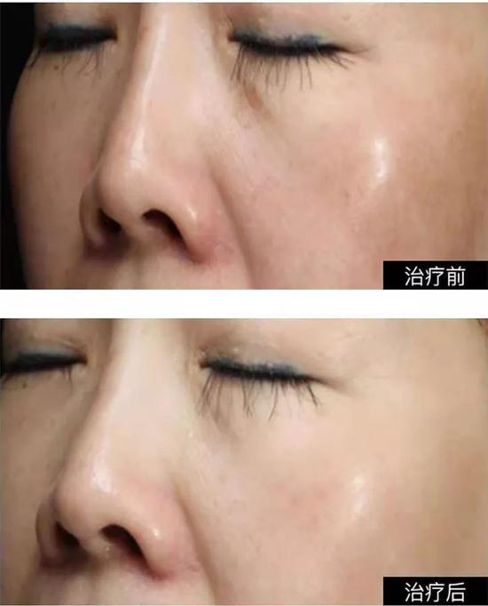 李晓宁医生入围临床案例效果