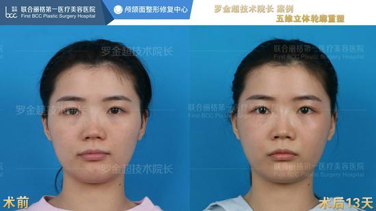 案例二:正面、仰面