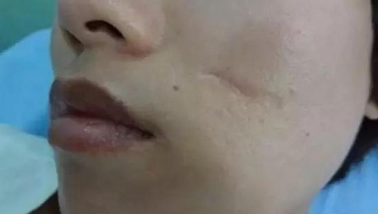 凹陷性瘢痕