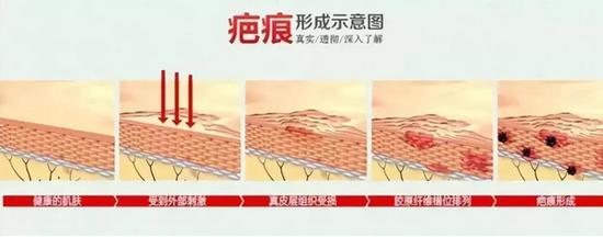 疤痕形成
