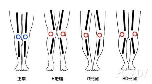 腿型