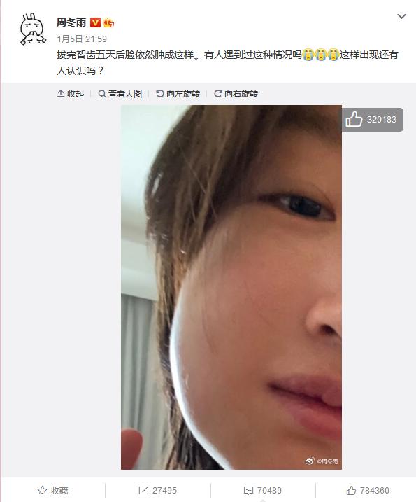 周冬雨拔完智齿脸变肿