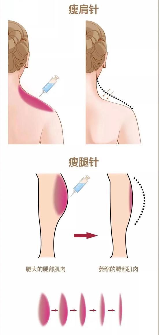 肉毒素注射后,2天就可以见效,1周后可明显看出效果,4周左右效果最佳。