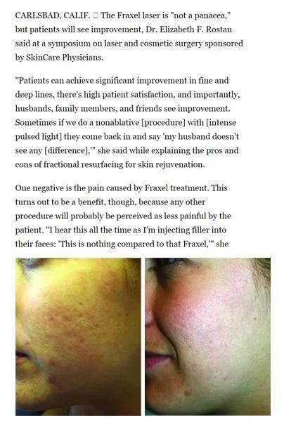 该患者接受了飞梭激光治疗痘坑。经过五次治疗,痘坑明显改善,皮肤变得细腻。照片由Elinzabeth F。 Rostan博士提供