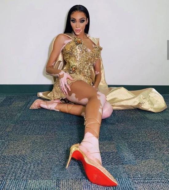 ▲Winnie Harlow