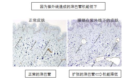 紫外线造成的淋巴管机能低下