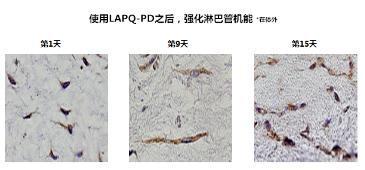 使用LAPQ-PD后 强化淋巴管机能