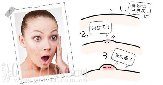 你的痘,你懂吗?