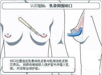 乳晕切口