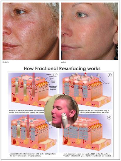 Tria Age-Defying Laser