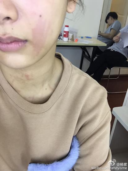 杨紫遭遇荨麻疹(图片来源:杨紫新浪微博)