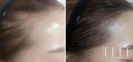 纹发际线