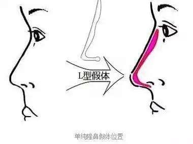 单纯L型假体隆鼻