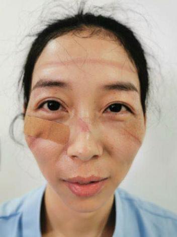 医护人员被口罩勒出印记 图片源于网络