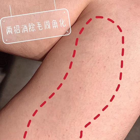 鸡皮肤