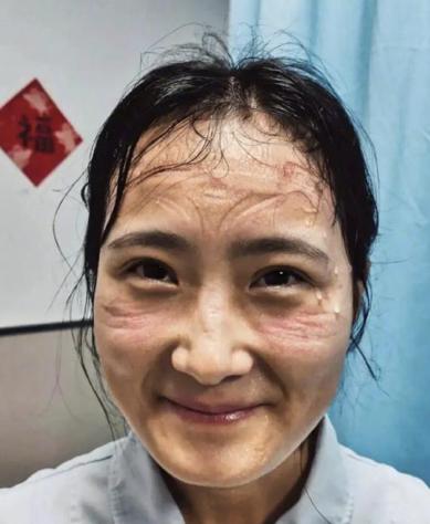 医护人员被口罩勒出印记 图片源于网络