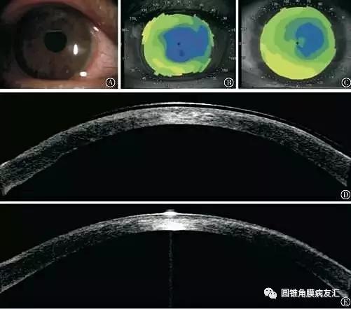基于角膜地形图的圆锥角膜诊断方法