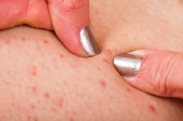 针灸可以治湿疹？5大穴位疗法让你祛湿止痒、清热解毒，不复发