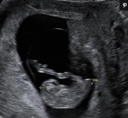 怀孕前三个月宝宝啥样，每周B超图告诉你胎儿发育情况，天然可爱