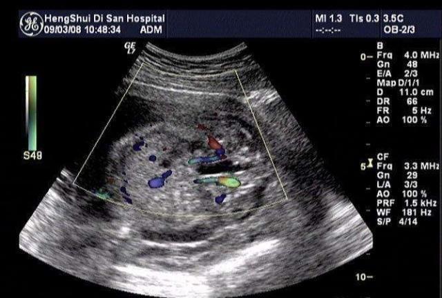 怀孕6个月，胎儿双侧“肾盂”未见分离，到底是男孩还是女孩？