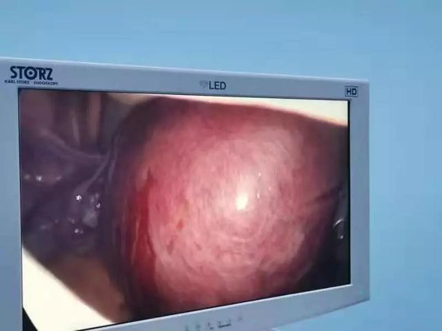 豫东医院妇产科利用微创阴式手术 成功切除巨大子宫肌瘤