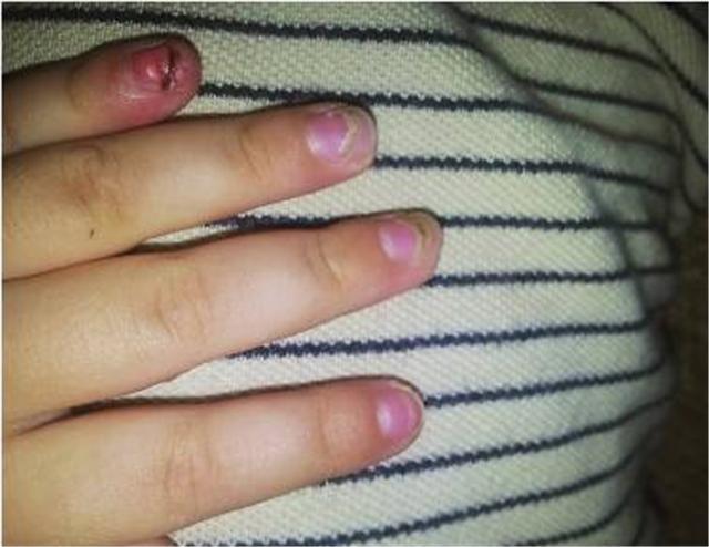 宝宝指甲上有白点是肚子里有蛔虫？长倒刺是缺乏维生素？