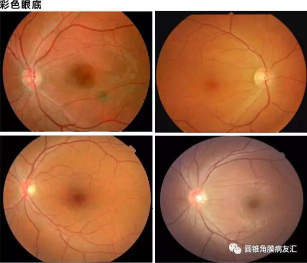 基于角膜地形图的圆锥角膜诊断方法