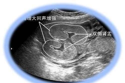 怀孕6个月，胎儿双侧“肾盂”未见分离，到底是男孩还是女孩？