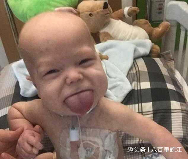 男婴患巨舌症舌头回不到嘴里,200万手术费愁坏父母!