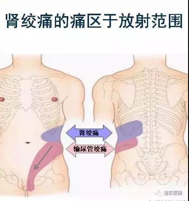 泌尿结石疼痛难忍 豫东医院精准碎石除忧患