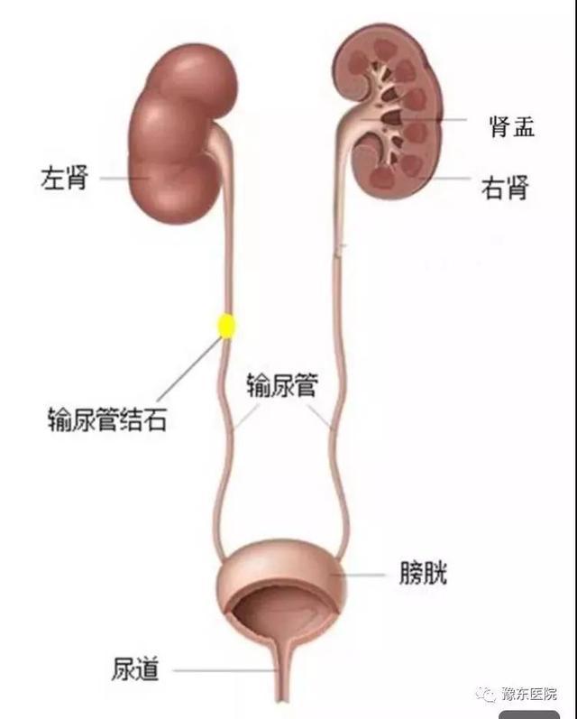 泌尿结石疼痛难忍 豫东医院精准碎石除忧患