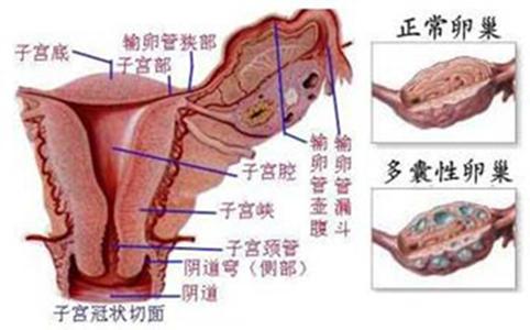 多囊卵巢综合征≠不孕，这些常识你知道吗