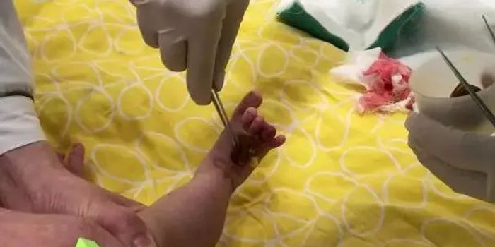 心疼!两个月大男婴脚趾发黑,险些截趾!竟是被这