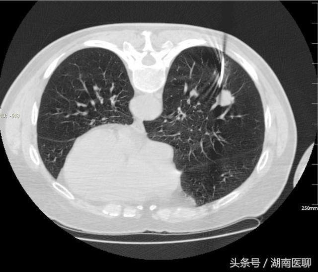 肺气肿后又患肺癌，79岁老人多处求医，这种疗法让他康复出院！