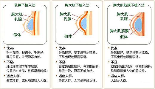 现在最流行硅胶假体隆胸术通常是在经腋窝、乳晕外缘或是乳房下皱襞等隐蔽处做切口,把选择好的假体植入胸大肌或乳腺下。目前胸大肌下植入较常见,相比乳腺下植入,不易损伤到乳腺组织,影响哺乳功能。 现在最流行硅胶假体隆胸术通常是在经腋窝、乳晕外缘或是乳房下皱襞等隐蔽处做切口,把选择好的假体植入胸大肌或乳腺下。目前胸大肌下植入较常见,相比乳腺下植入,不易损伤到乳腺组织,影响哺乳功能。