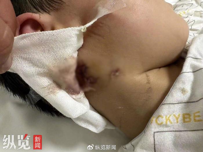 小星脖颈处缝合的伤口(来源/网络)