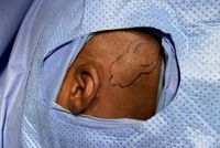 10天攻坚！逸仙医院助非洲籍少年重获听力