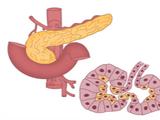 胰腺癌的病因、高危人群及防治