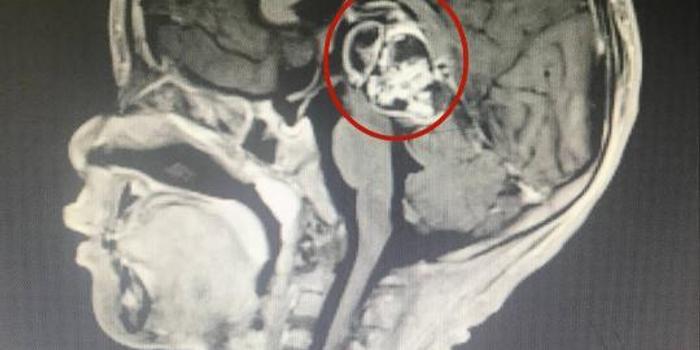 5岁男童脑里长头发 原是生出畸胎瘤