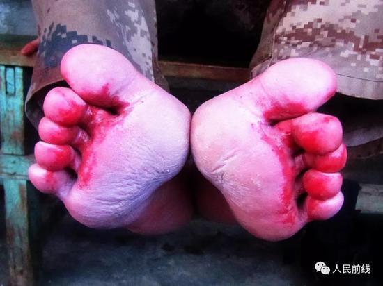 或许很多人这一辈子都没想过,有一天蚂蟥会成为军人的“敌人”。