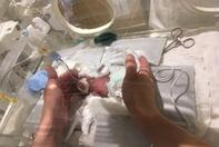 “世界最小的男婴”平安出院 出生时仅268克