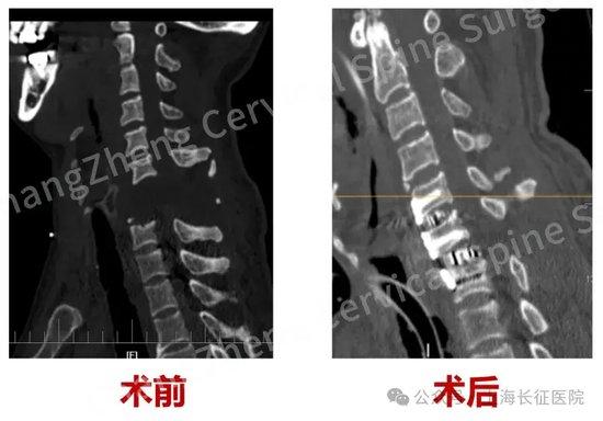 全球罕见!中国医生救回“身首离断”患者