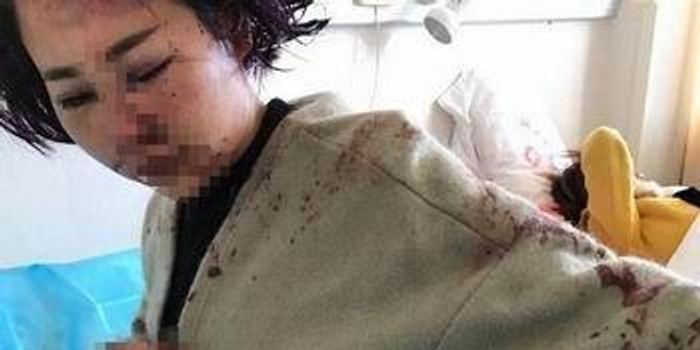 丽江被打女子做二次伤情鉴定