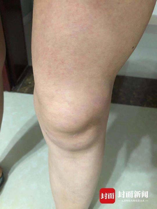 余女士稱(chēng)出現(xiàn)積液的膝蓋。