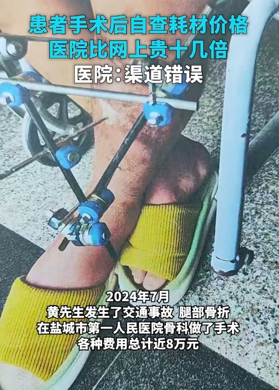 患者术后自查耗材价格,医院比网上贵十几倍,医院:购买方式不对导致
