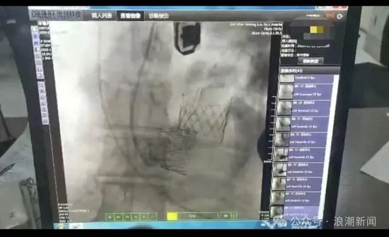 心脏瓣膜出厂价3万多,医院收28万,西安交大一附院:发现超医保支付范围等问题26项,涉及金额75060.4元