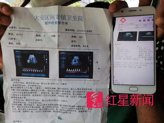 此前,两家医院的彩超检查结果显示均为“双胞胎”